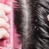 Melawan Ketombe: Tips untuk Mengatasi Masalah Rambut yang Mengganggu Kenyamanan dan Rasa Percaya Diri