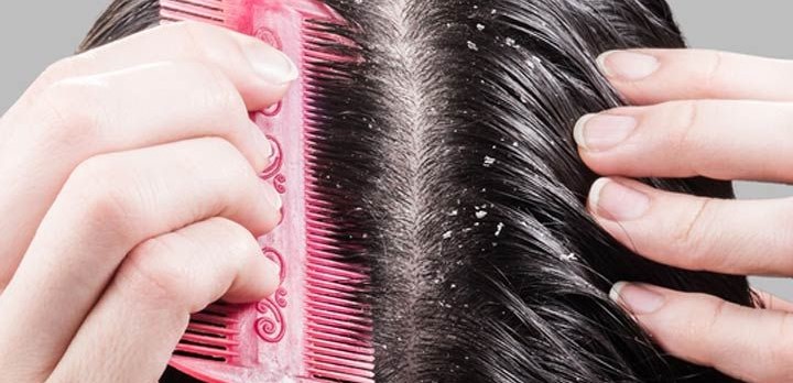 Melawan Ketombe: Tips untuk Mengatasi Masalah Rambut yang Mengganggu Kenyamanan dan Rasa Percaya Diri