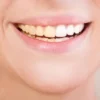Tips Menghilangkan Kuning Pada Gigi