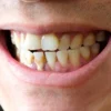 Gigi Berkarang Kuning? Pakai 5 Bahan Yang Gampang Untuk Merontokkan Garang Gigi