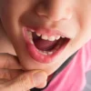 Penyebab Gigi Hitam pada Anak (Foto/Alodokter)
