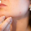 Tips Memilih Skincare untuk Kulit Berjerawat (Pixabay/Kjerstin_Michaela)